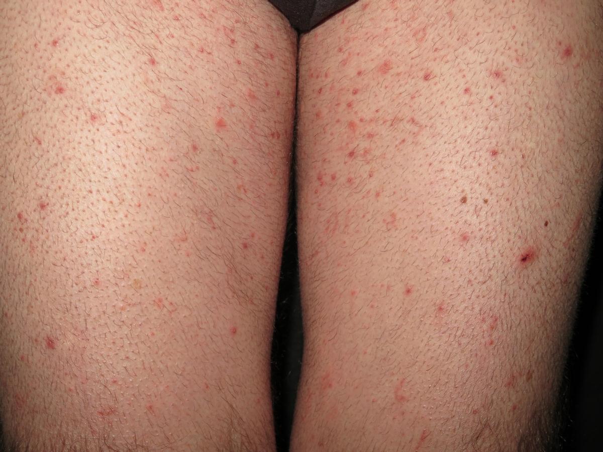 aumento sarna España