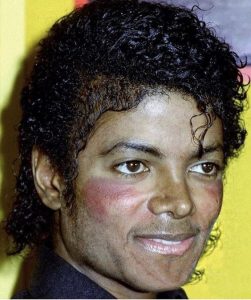 Síntomas de lupus en Michael