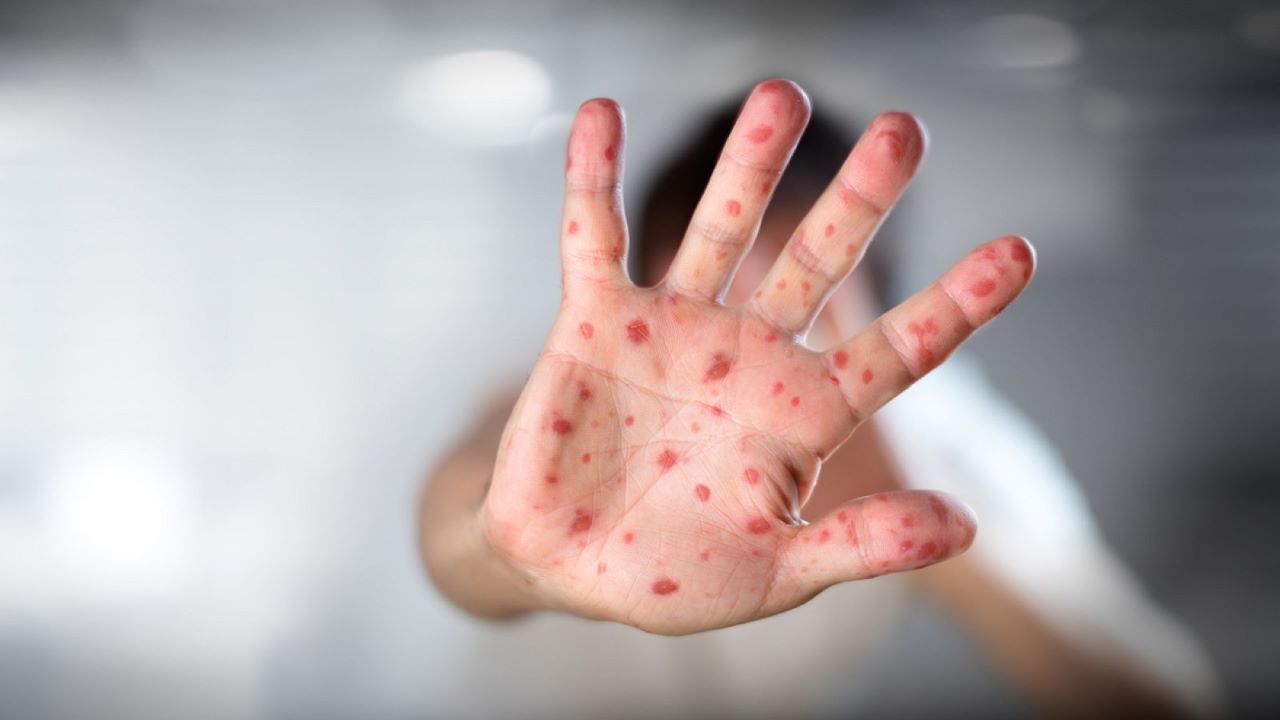 El sarampión regresa de la mano de la inmigración marroquí y rumana