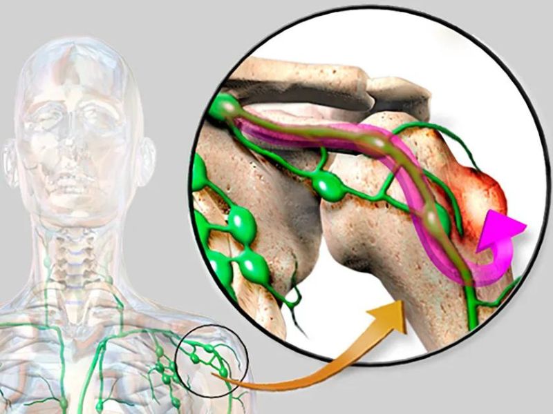 plasticidad celular linfoma