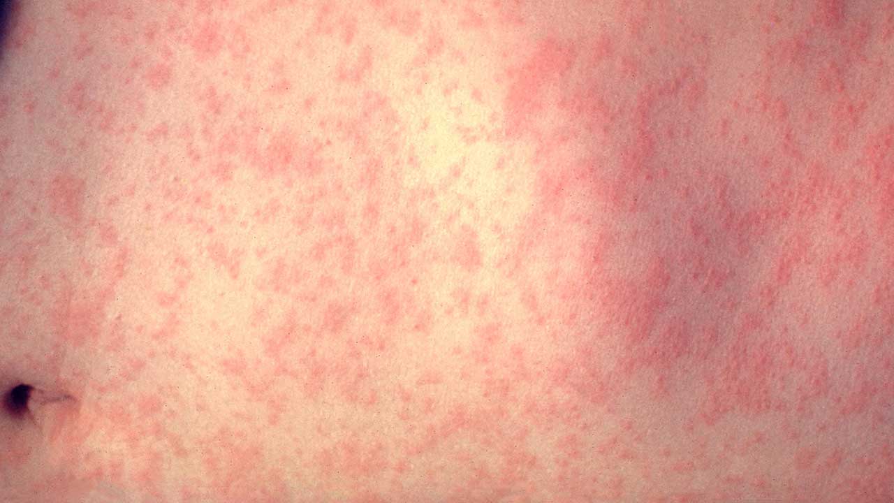 La OMS da un golpe a España y le retira el estatus de país libre de sarampión tras dispararse los contagios