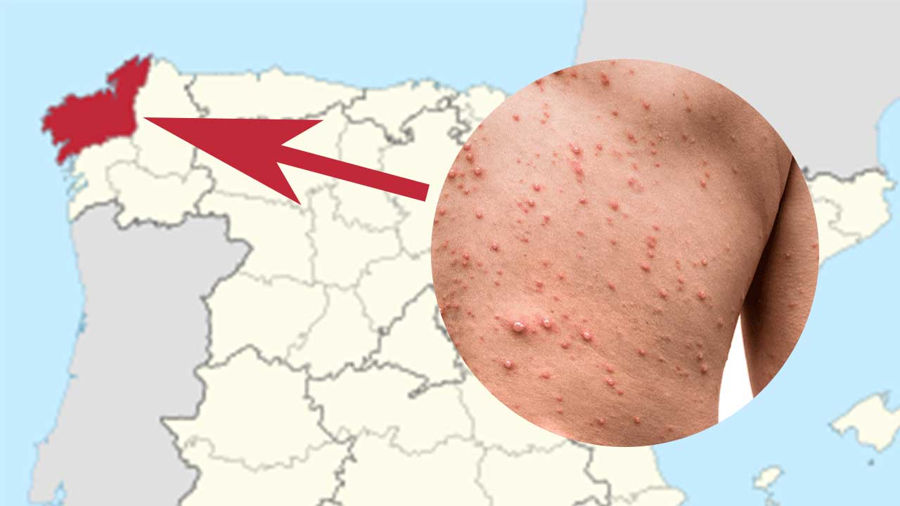 brote viruela del mono Galicia